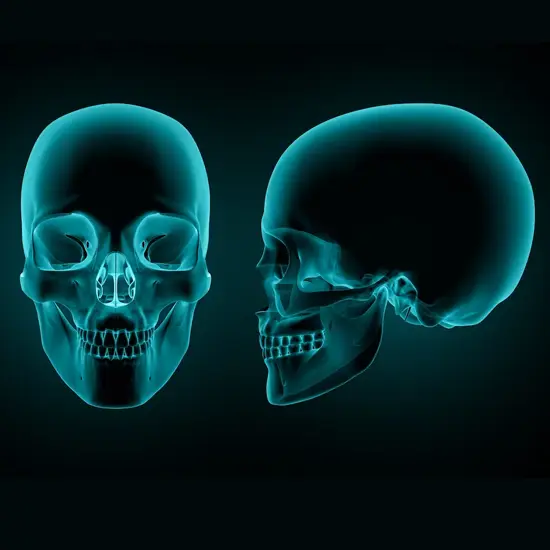 CT Facial Bone 3D